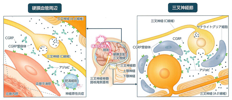 アジョビによる片頭痛発作の発症抑制